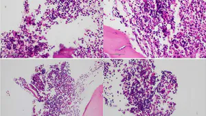 Severe Low Vitamin B12 Levels with Macrocytosis and Associated Hemolytic Anemia, Mimicking Thrombocytopenic Thrombotic Purpura: A Case Report and Literature Review