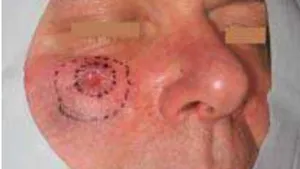 Plastic Coverage of a Lentigo-Maligna Defect in the Cheek, an Alternative Practice Concept