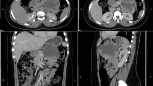 Management of a Solid Pseudopapillary Tumor of the Pancreas in a Country with Limited Resources: About a Case