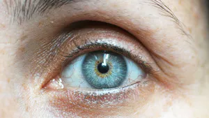 Glaucoma Secondary to Uveitis Due to Posner Schlossman Syndrome