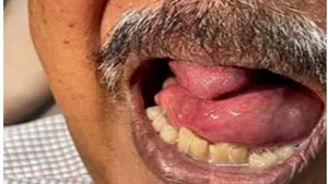 A Rare Benign Multilobulated Floor of Mouth Lesion