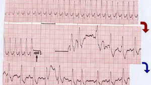 Atrial Flutter with 1:1 Atrioventricular Conduction