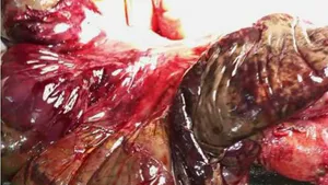 Acute intestinal Obstruction: Diagnostic and Therapeutic Aspects at the Sino Central African Friendship University Hospital in Bangui, Central African Republic