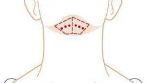 Effectiveness and Safety of Treatment of Double Chin with Combined Enzymatic Therapy