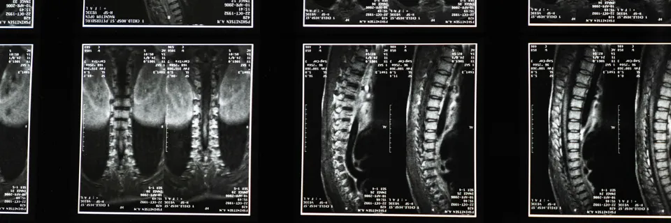 A Patient with Symptomatic Polyostotic Melorheostosis Successfully Treated with Intravenous Zoledronate Injection- A Case Report