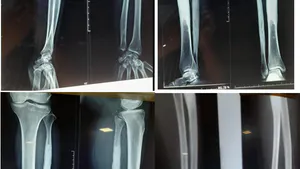 A Patient with Symptomatic Polyostotic Melorheostosis Successfully Treated with Intravenous Zoledronate Injection- A Case Report