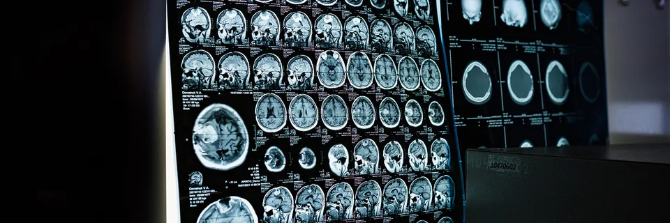 Chikungunya Virus as a Trigger for Guillain-Barré Syndrome