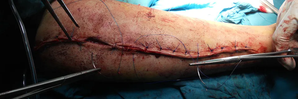 Cephalic Screw Migration After Hip Fracture