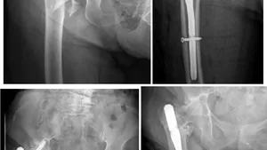Intrapelvic Migration of Cephalic Screw: Report of two Cases and Review of the Literature
