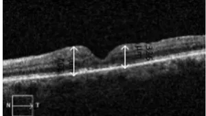 Analysis of the Surgical Treatment Results of Large Idiopathic Macular Holes using Tamponade with Internal Limiting Membrane Flaps and Platelet-Rich Plasma