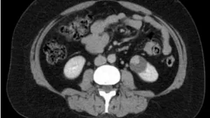 Renal Leiomyoma as a Bosniak IV Lesion: A Case Report