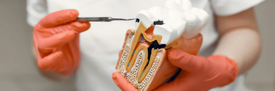 Calcium Hydroxide Apexification in Immature Tooth