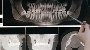 Calcium Hydroxide Induced Apexification in an Immature, Non-Vital Permanent Tooth – A Case Report