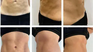 Clinical and Histological Findings Following a Single Session of Recombinant Enzymes Applied to the Abdomen of Patients with Fibrosis Sequelae from Liposuction