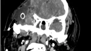 Invasive Meningioma of the Infratemporal Fossa. Case Report and Review of the Literature