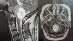 A Vascular Benign Lesion in a Perilous Location