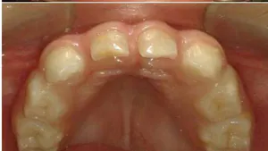 Dental Care for Kabuki Syndrome Patient: a Case Rport