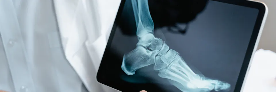 Casting a Path to Improved Outcomes: The Crucial Role of Total Contact Corrective Casts in Charcot Neuroarthropathy Treatment