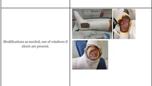 Casting a Path to Improved Outcomes: The Crucial Role of Total Contact Corrective Casts in Charcot Neuroarthropathy Treatment