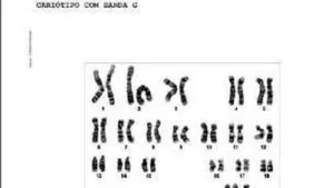Relationship between Triple X Trisomy and ASD in A 2-Year-Old Child in Bom Despacho/Mg