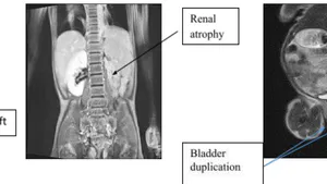 Urogenital Abnormalities Associated to Anorectal Malformations and Hirschsprung’s Disease