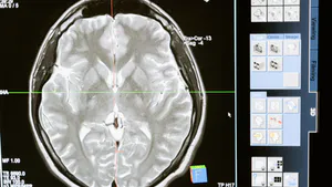 Bilateral Thalamic Stroke in a Young Adult: A Rare Presentation of Artery of Percheron Infarction