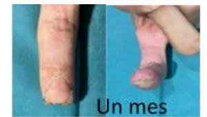 Flaps vs. Wet Dressings for Fingertip Injuries in Occupational Patients