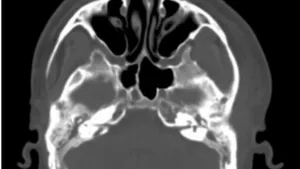 Bilateral Mastoiditis Complicated by Unilateral Zygomaticitis – Rare form, Challenging Diagnosis