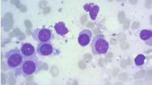 Controlled Comorbidities, Uncontrolled Malignancy: A Case of Early Detection in Complex CKD Patients